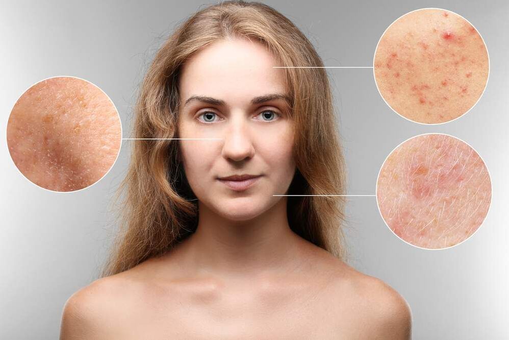 rashes on face due to parasites